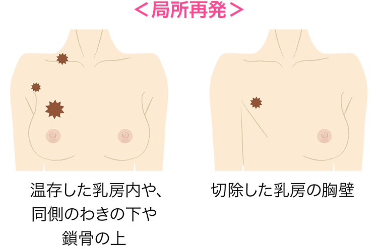 肺がんの患者数 主な部位別がん死亡率の年次推移 男性